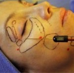 Stem cell facial
