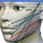 Threadlift face and neck
