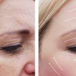 blepharoplasty