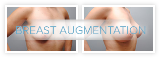 breast enhancement hartford Breast enhancement hartford