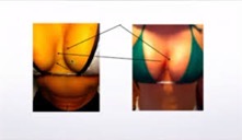 Vampire Breast Lift cleavage