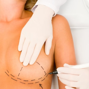 Ask Ellen About Breast Reduction & Breast Lift