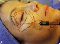 2018 Innovation: The Stem Cell Facelift