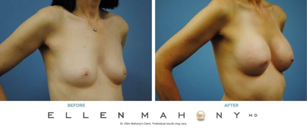 Before and After Image: Case #3010 - right-front-oblique