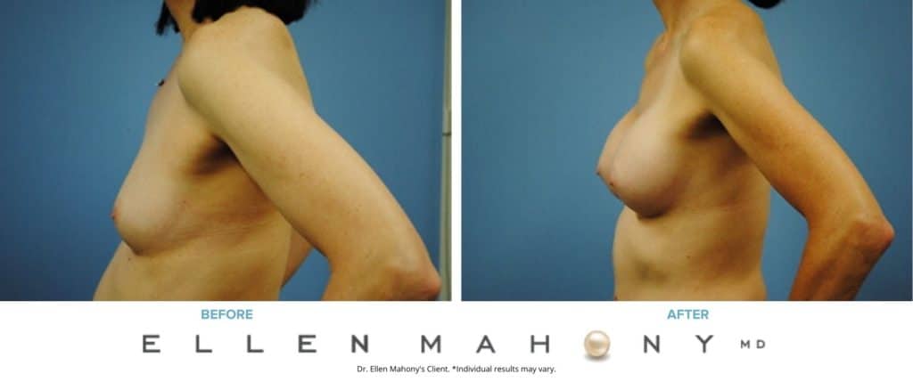 Before and After Image: Case #3010 - left-side