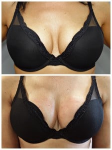 The Vampire Breast Lift: Finally, a Non-Surgical Solution for Breast Enhancement!