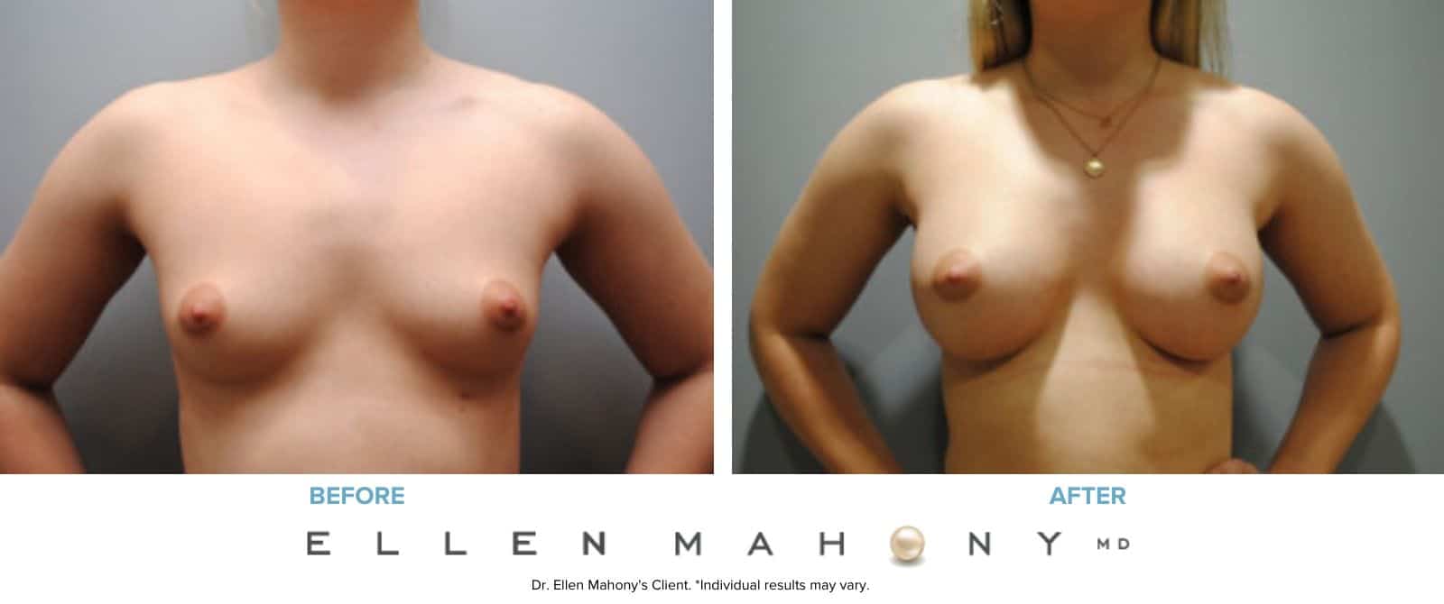 Before and After Image: Case #6928 - front