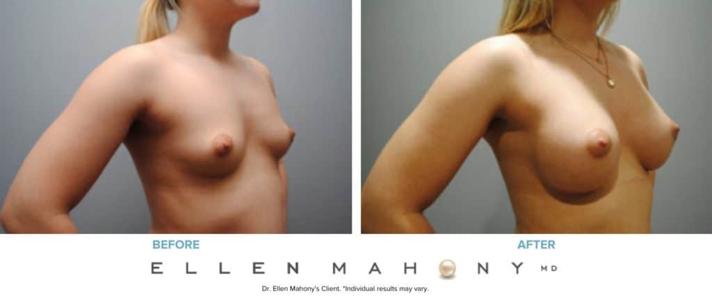 Before and After Image: Case #6928 - right-front-oblique