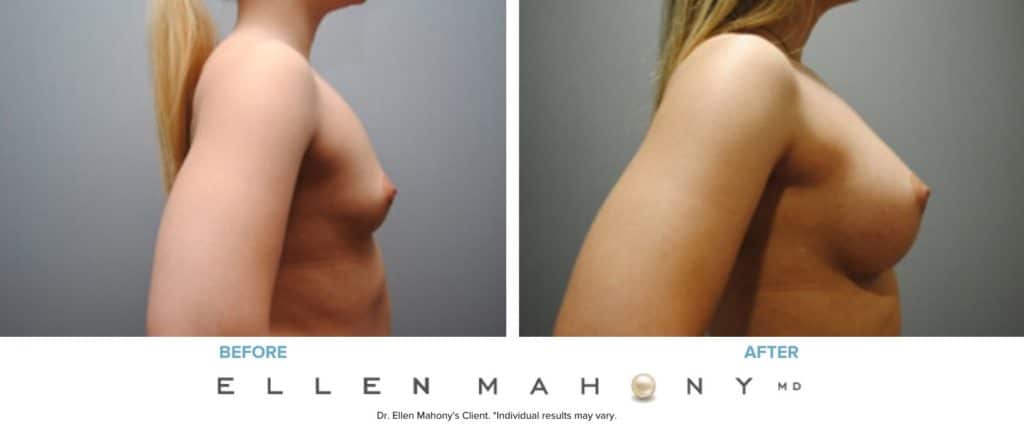 Before and After Image: Case #6928 - right-side