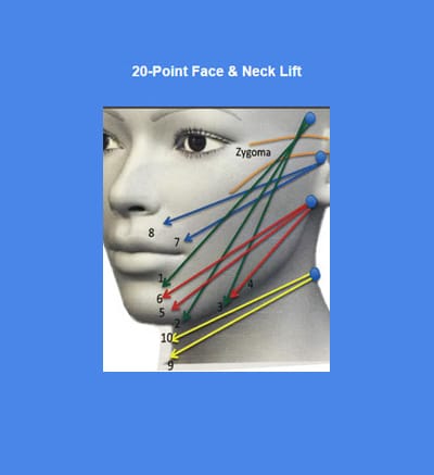 3 Advantages of Doing a Threadlift in October
