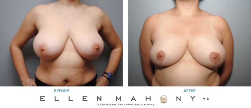 Before and After Image: Case #7963 - front