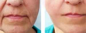 3D Approach to Lip Lines: Finally, A Solution for the Aging Mouth that Works!