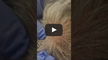 PRP Hair Restoration Treatment #1