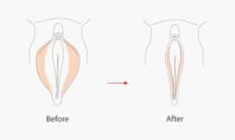 Labiaplasty Westport CT