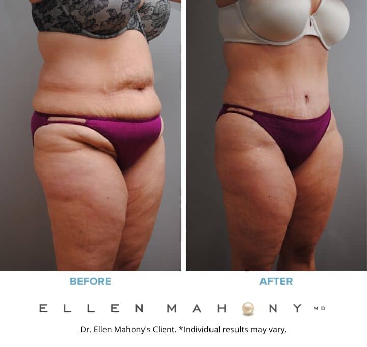 Tummy Tuck Westport CT | Dr. Ellen Mahony