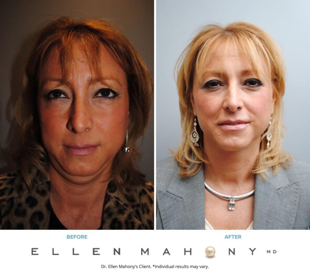 Face Lift/Neck Lift Westport CT | Dr. Ellen Mahony