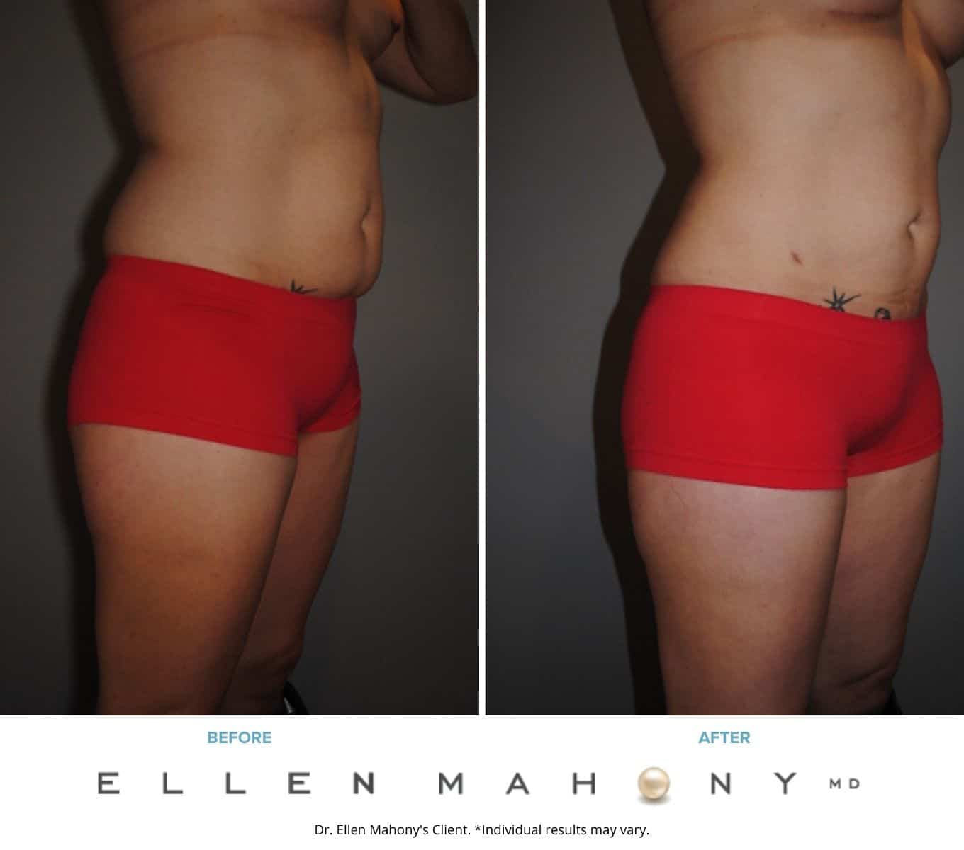 Liposuction Westport CT | Dr. Ellen Mahony