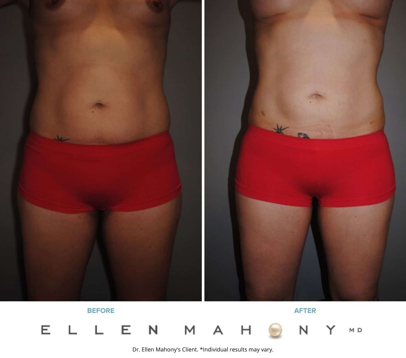 Liposuction Westport CT | Dr. Ellen Mahony