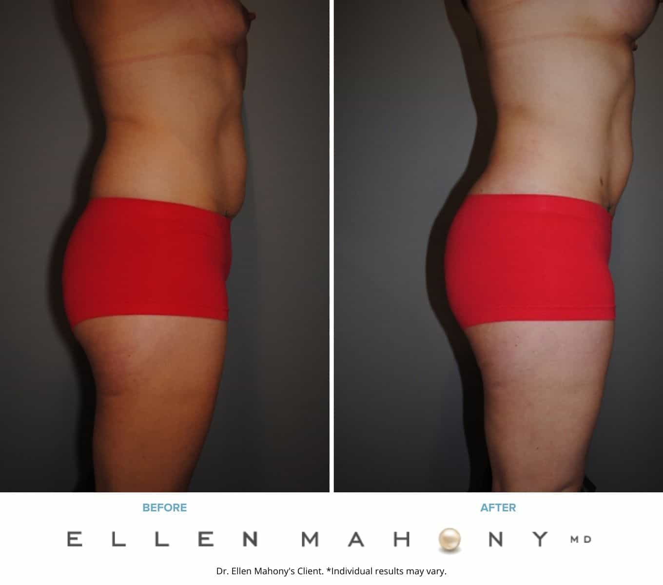 Liposuction Westport CT | Dr. Ellen Mahony