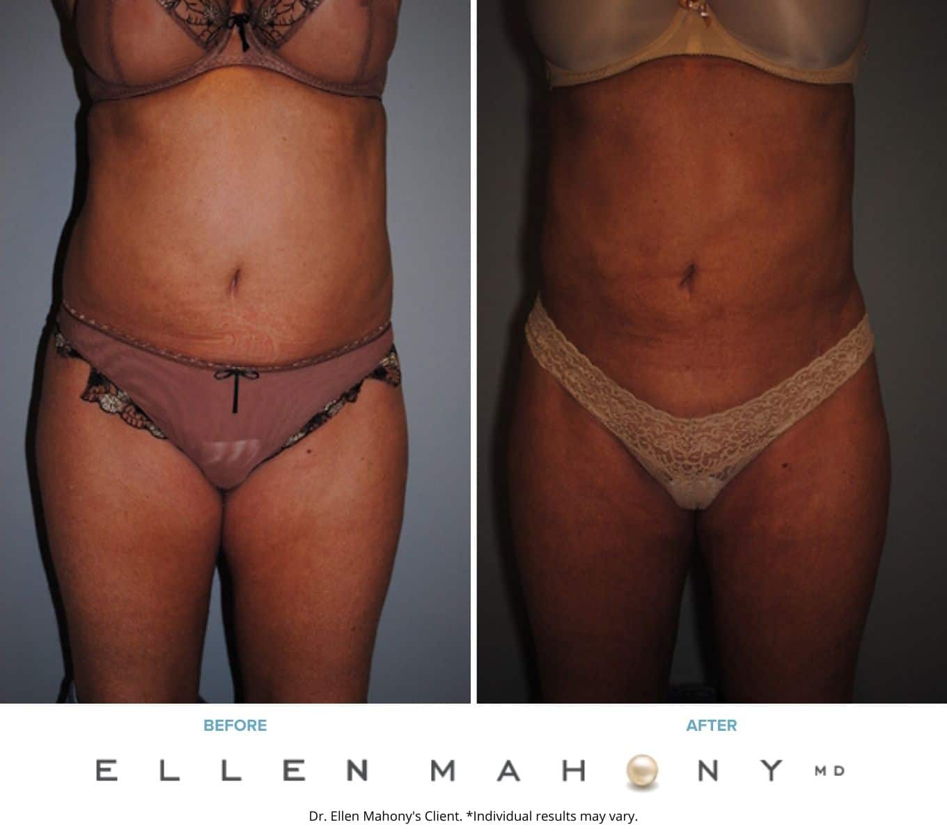 Liposuction Westport CT | Dr. Ellen Mahony