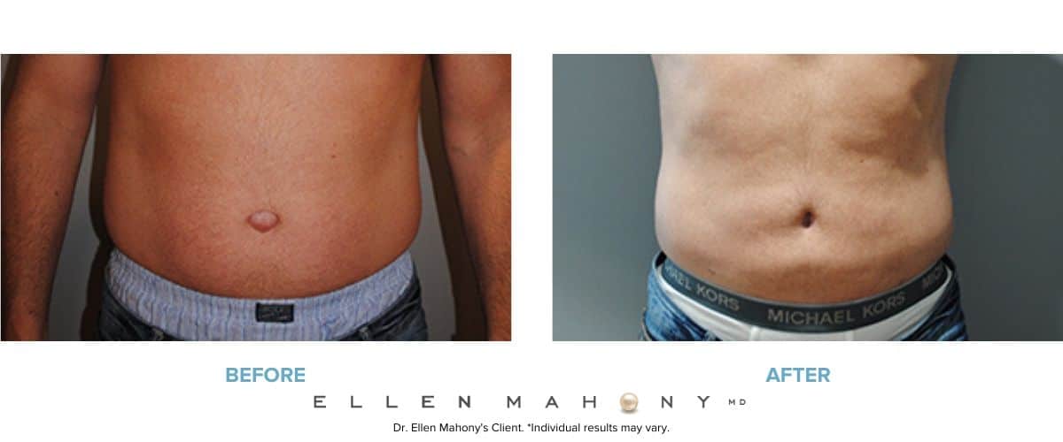 Liposuction for Men Westport CT | Dr. Ellen Mahony