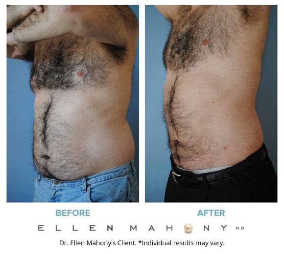 Liposuction for Men Westport CT | Dr. Ellen Mahony