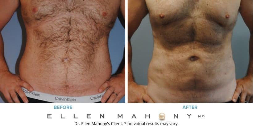 Liposuction for Men Westport CT | Dr. Ellen Mahony