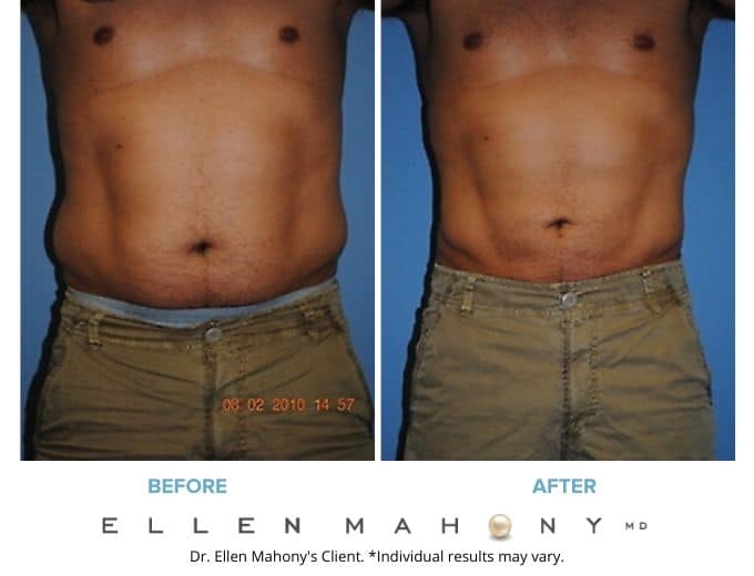 Liposuction for Men Westport CT | Dr. Ellen Mahony