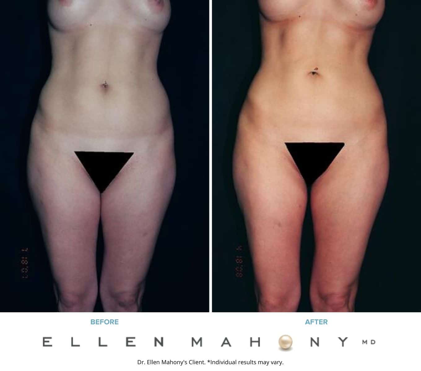 Liposuction Westport CT | Dr. Ellen Mahony