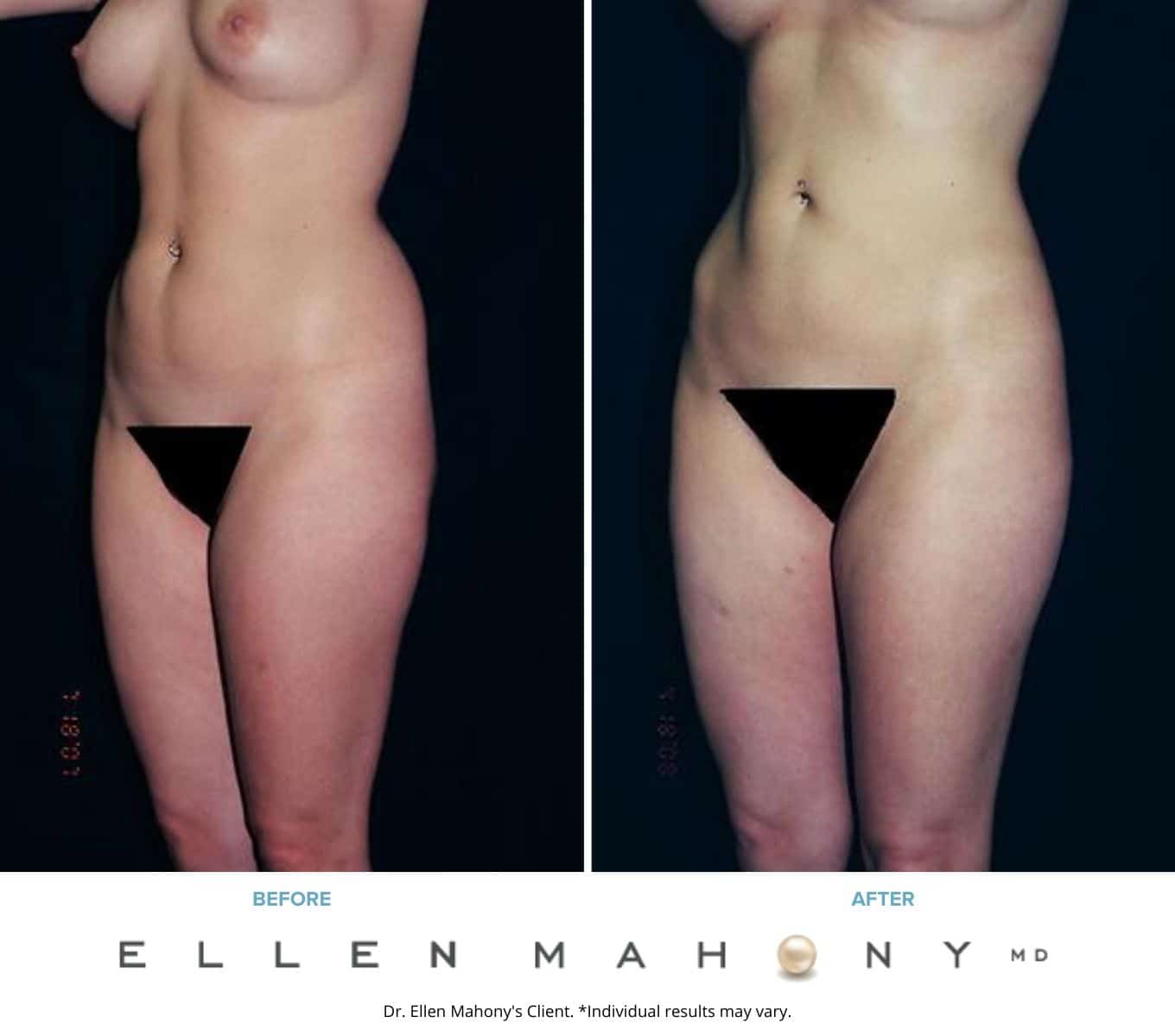 Liposuction Westport CT | Dr. Ellen Mahony