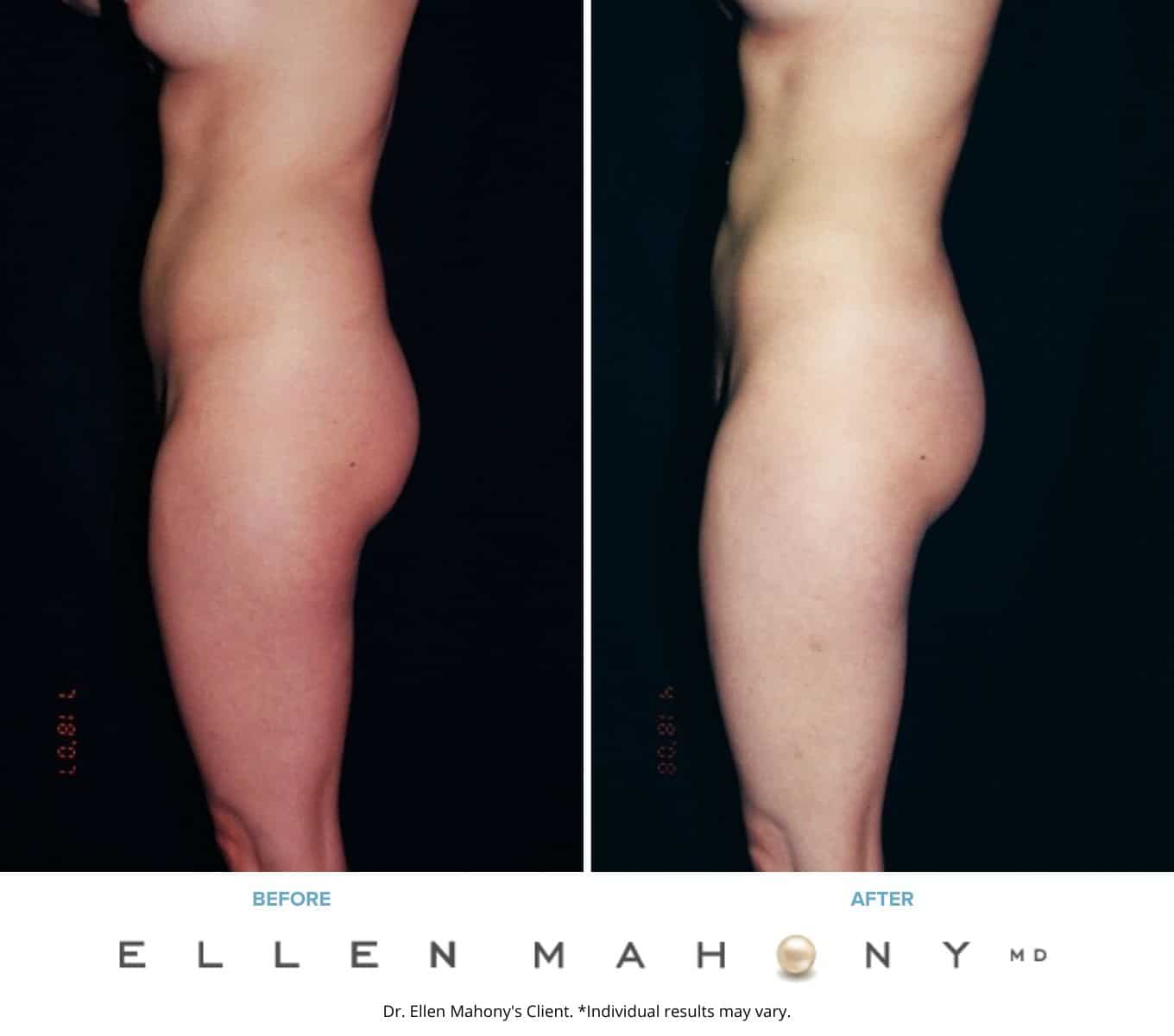 Liposuction Westport CT | Dr. Ellen Mahony