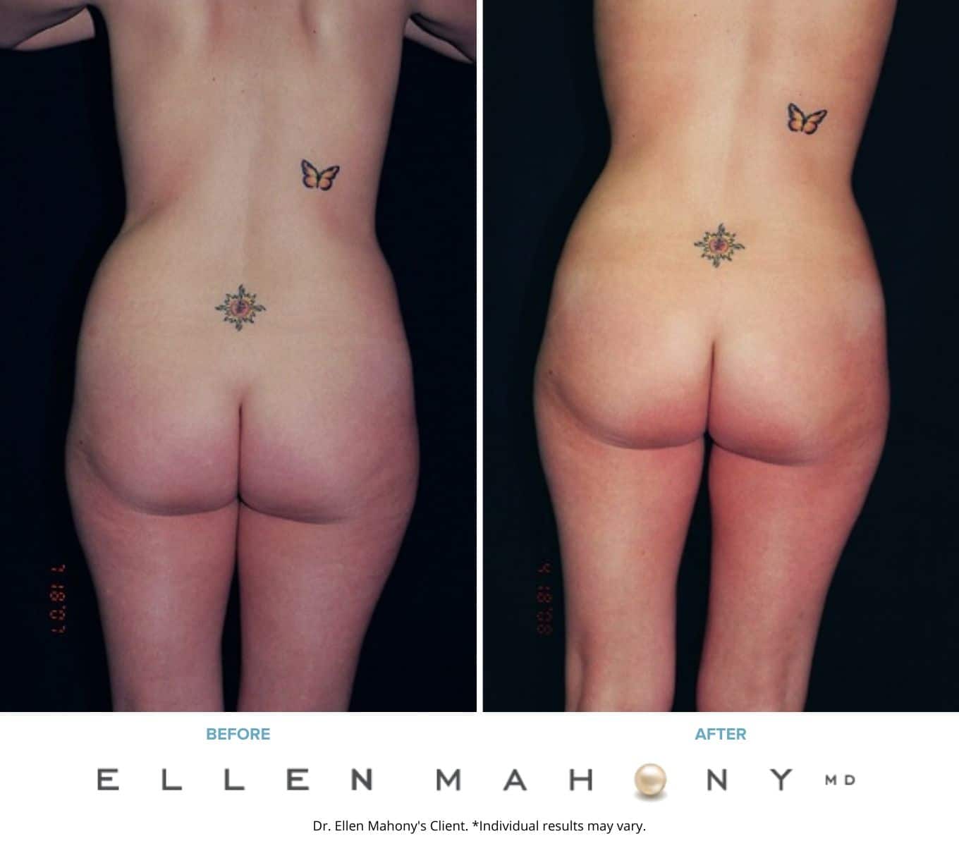 Liposuction Westport CT | Dr. Ellen Mahony