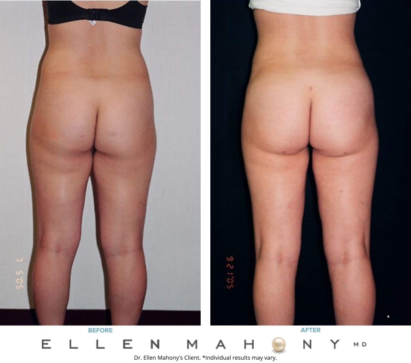 Liposuction Westport CT | Dr. Ellen Mahony