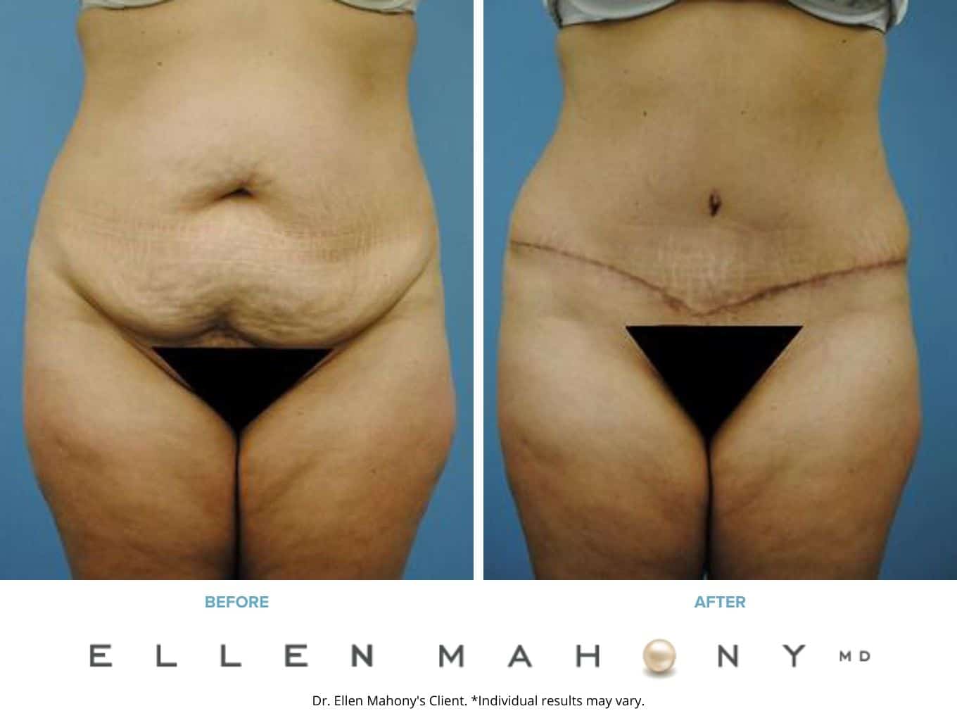 Tummy Tuck Westport CT | Dr. Ellen Mahony