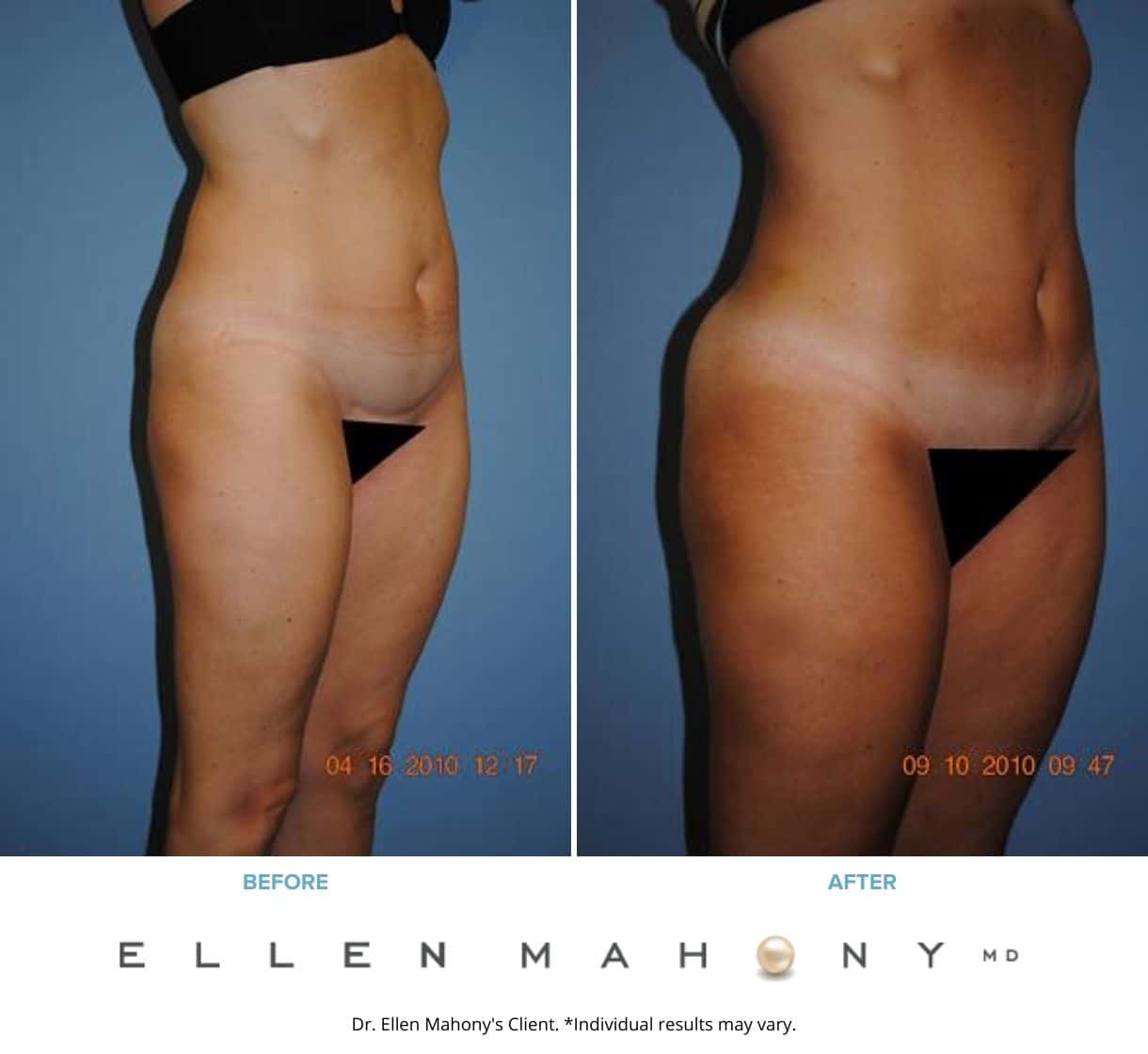 Mini Tummy Tuck Westport CT | Dr. Ellen Mahony