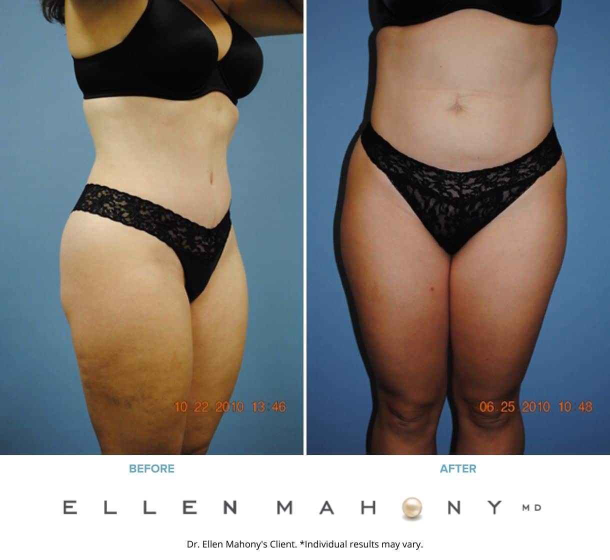 Tummy Tuck Westport CT | Dr. Ellen Mahony