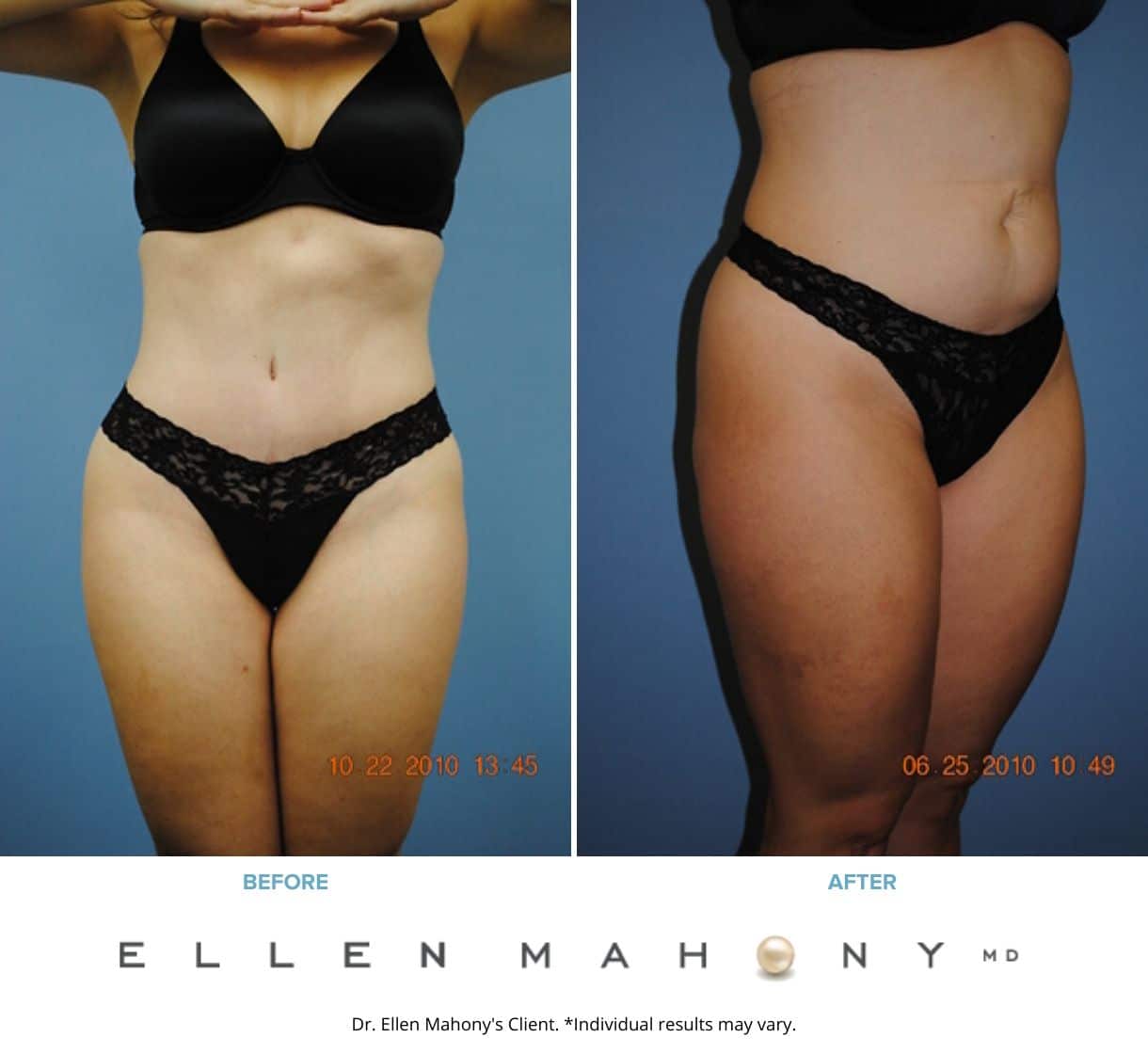 Tummy Tuck Westport CT | Dr. Ellen Mahony