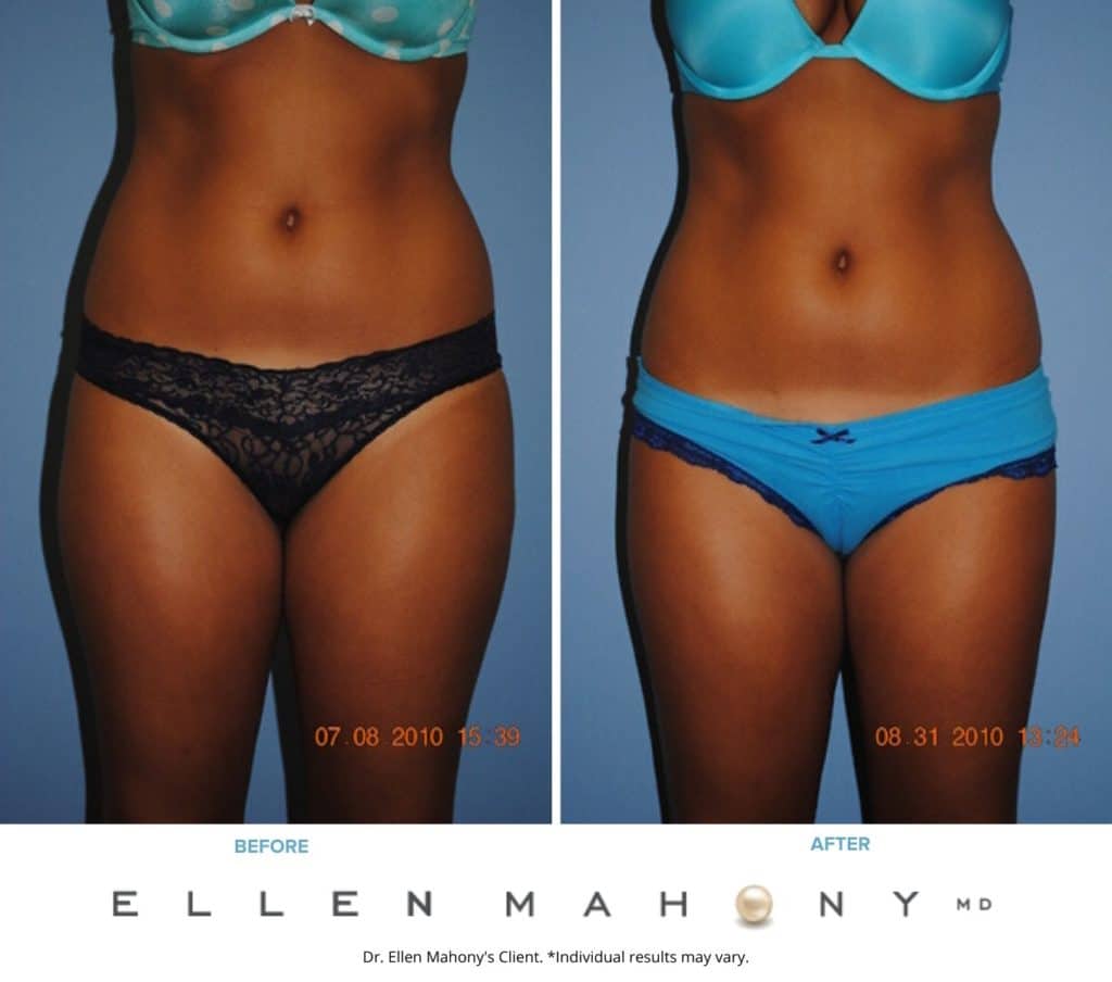 Liposuction Westport CT | Dr. Ellen Mahony