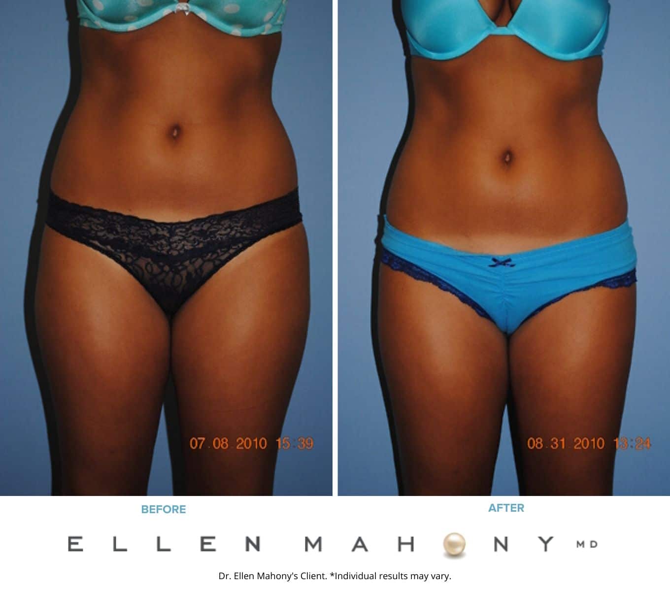 Liposuction Westport CT | Dr. Ellen Mahony