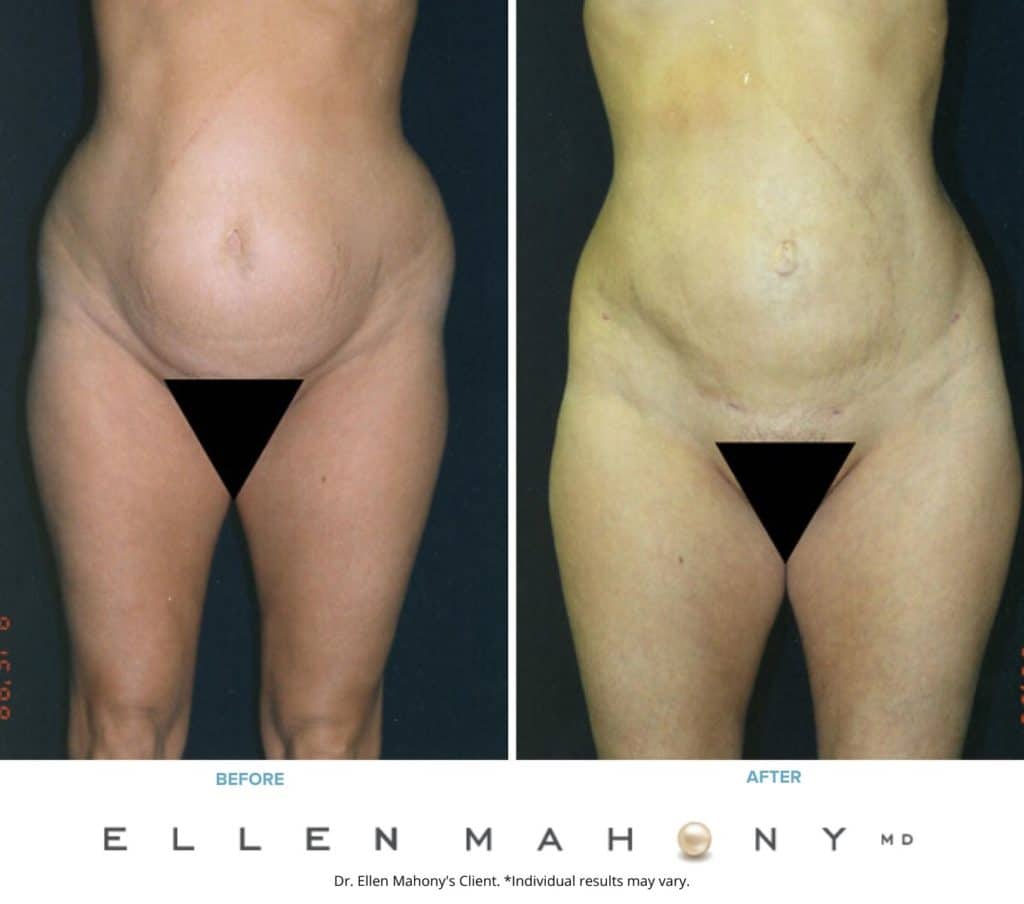 Liposuction Westport CT | Dr. Ellen Mahony