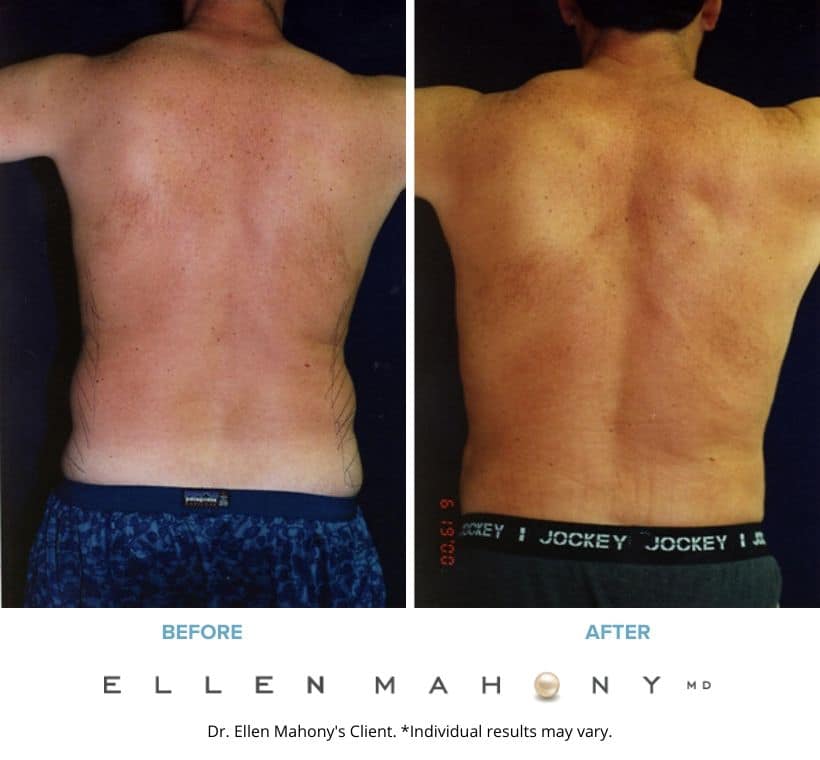 Liposuction for Men Westport CT | Dr. Ellen Mahony