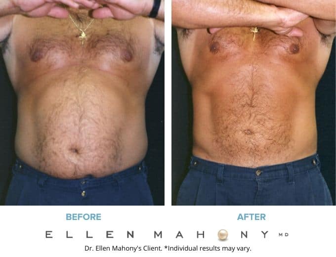 Liposuction for Men Westport CT | Dr. Ellen Mahony