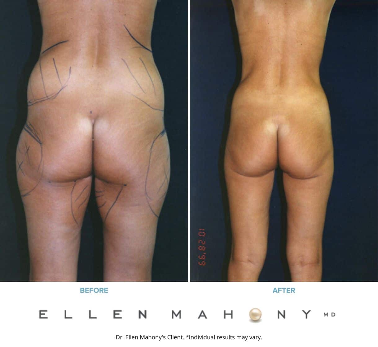 Liposuction Westport CT | Dr. Ellen Mahony