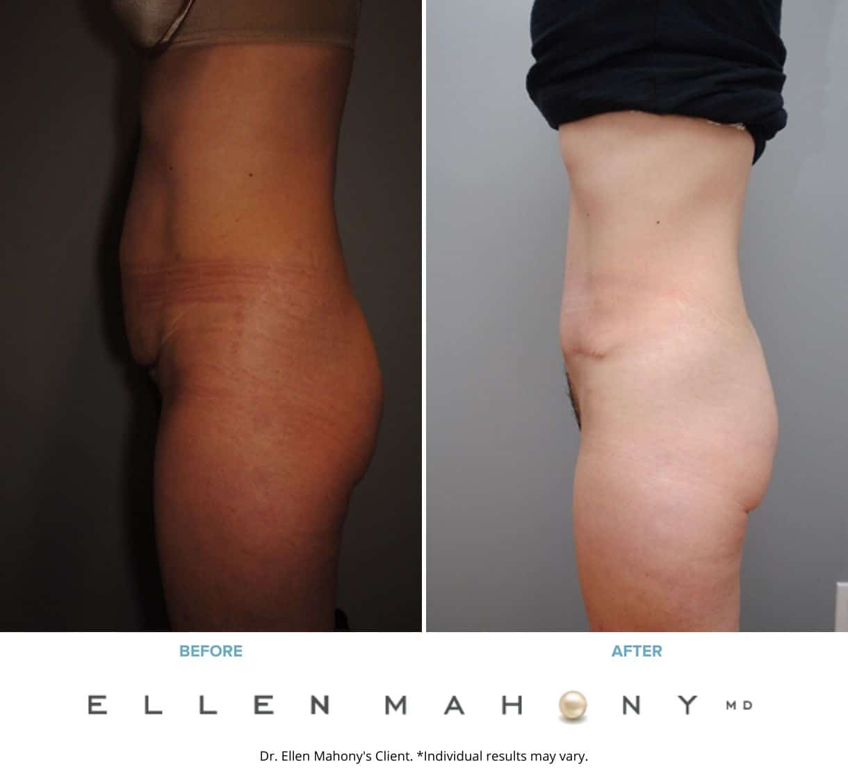 Tummy Tuck | Westport CT | Dr. Ellen Mahony