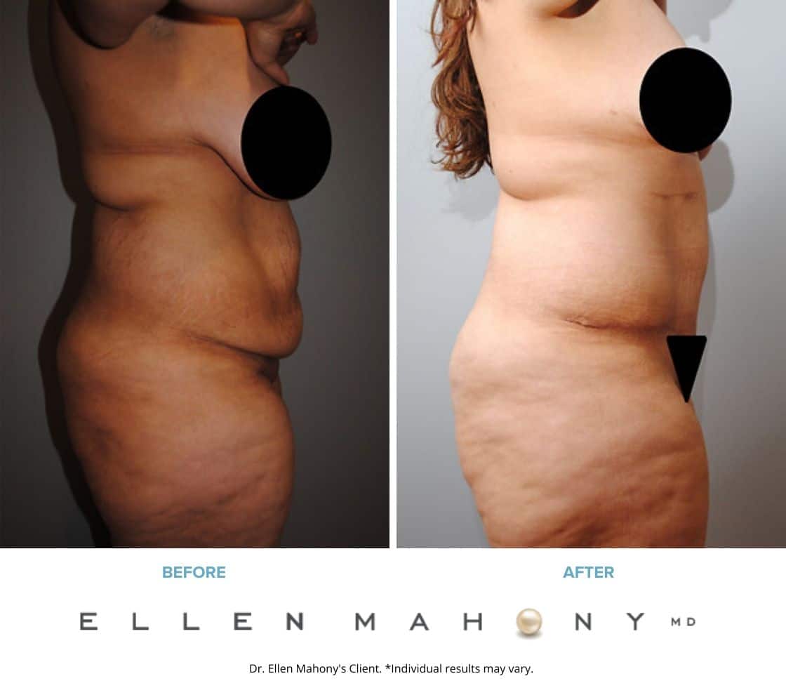 Tummy Tuck | Westport CT | Dr. Ellen Mahony