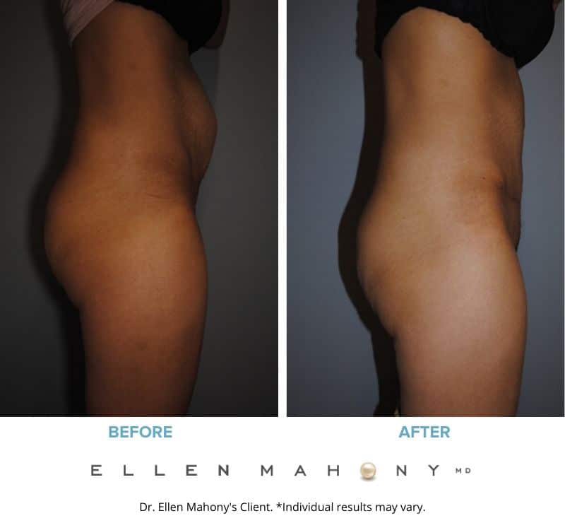 Tummy Tuck | Westport CT | Dr. Ellen Mahony