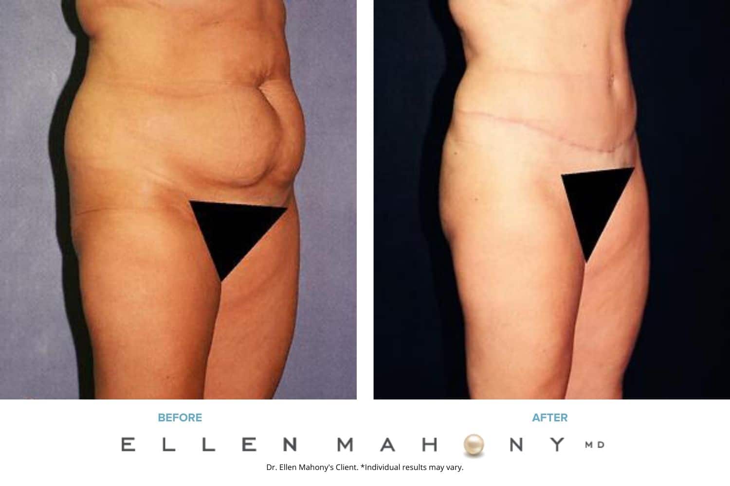 Vertical Scar Tummy Tuck | Westport CT | Dr. Ellen Mahony