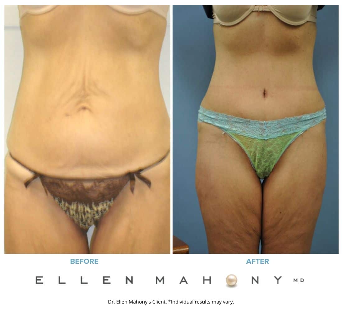 Tummy Tuck | Westport CT | Dr. Ellen Mahony