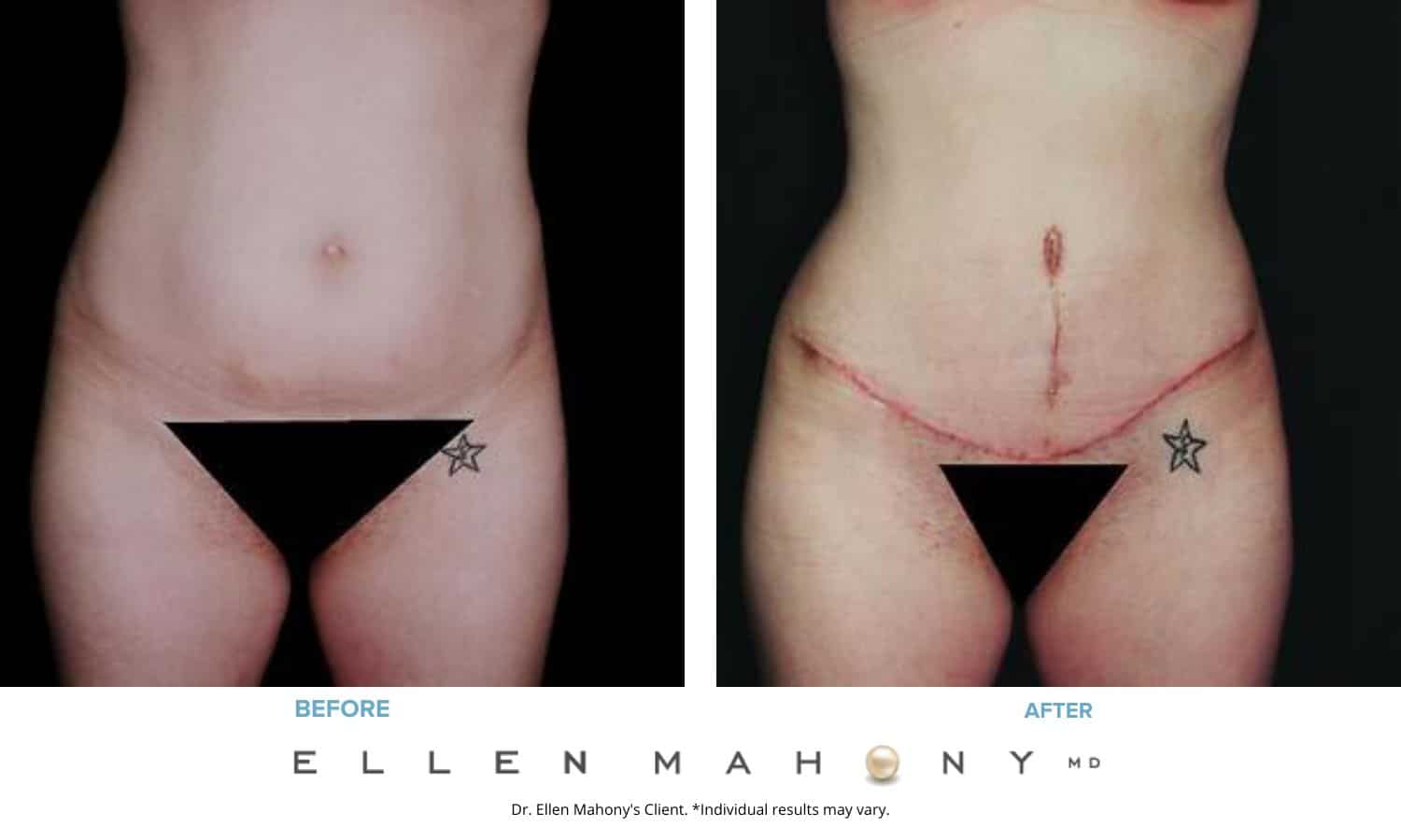 Vertical Scar Tummy Tuck | Westport CT | Dr. Ellen Mahony