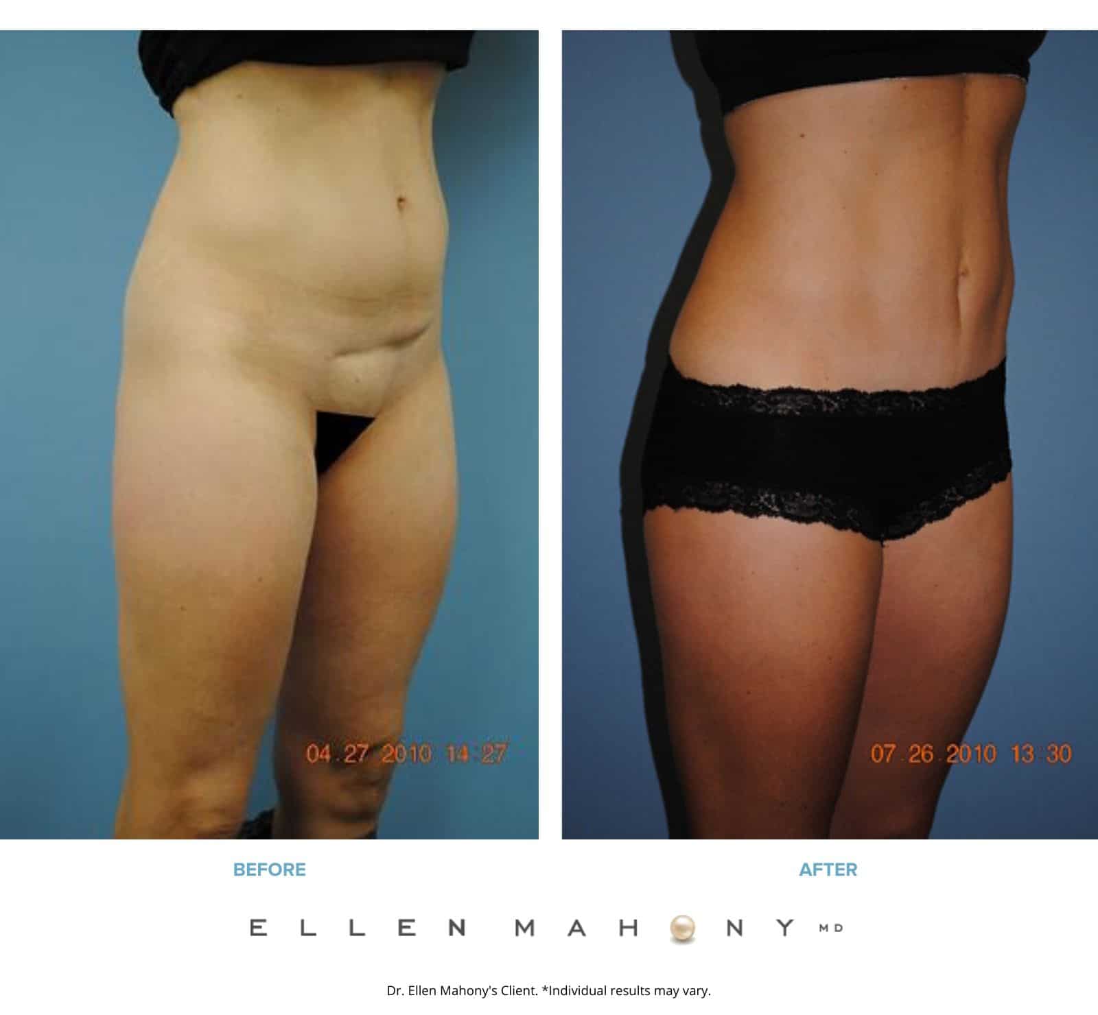 What is a Mini Tummy Tuck and How Does it Work?